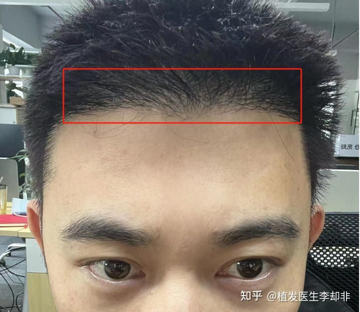 上海哪家植发比较靠谱(上海哪家植发机构比较好)
