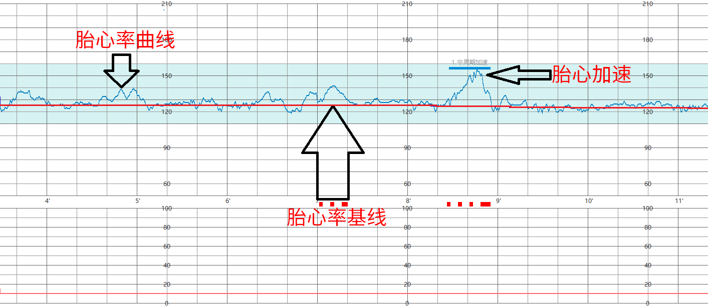 在胎心率基線確定後,才能標定出一次胎心加速圖型,且可以準確測算出