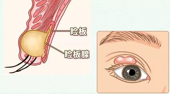 腺口在眼皮边缘,靠近眼睫毛的地方,睑板腺会一刻不停地分泌一种像油脂