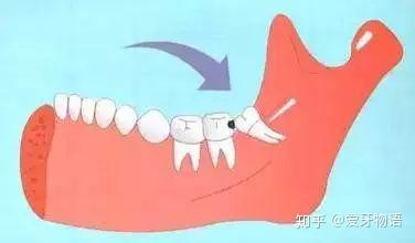 为什么医生都建议拔掉智齿呢 知乎