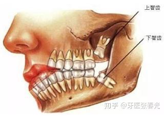 当智齿来敲门：你准备好迎接它们的到来了吗？