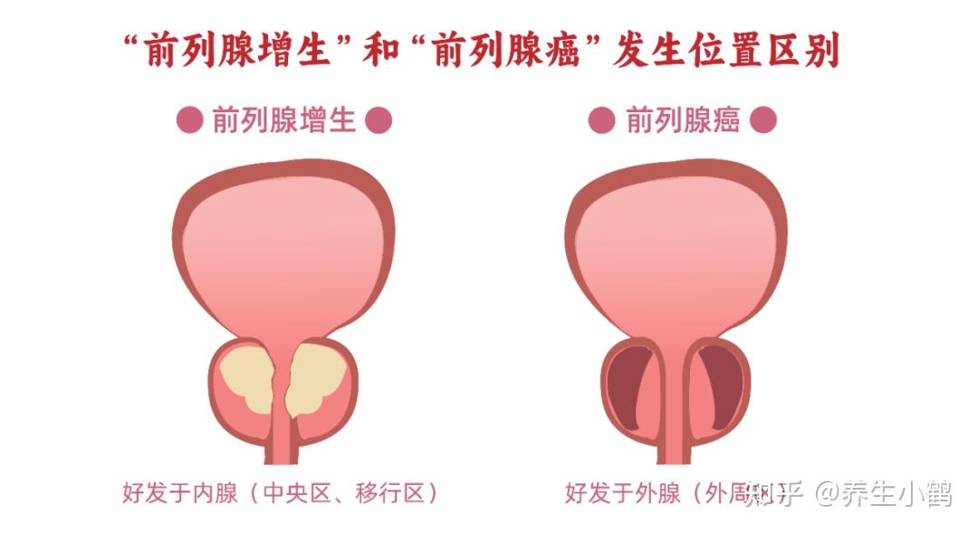 【诊疗指南】必收藏:怎么看前列腺各项检查单+治疗方案建议 - 知乎