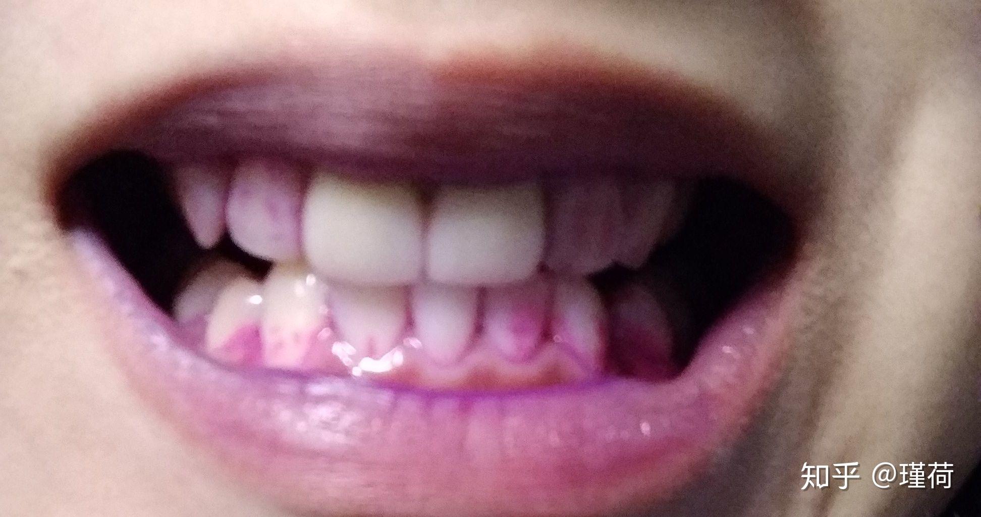 蛀牙 龋齿牙齿 - 知乎