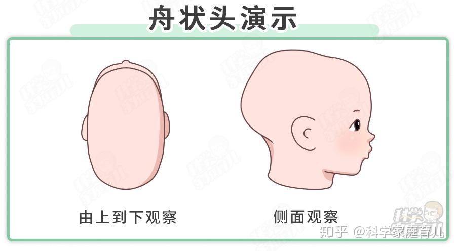 娃偏头、扁头会伴随一生?专家:千万别错过矫正“黄金期” - 知乎