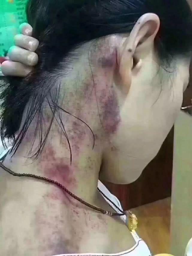 带脉刮痧清肠减腹让你瘦的健康