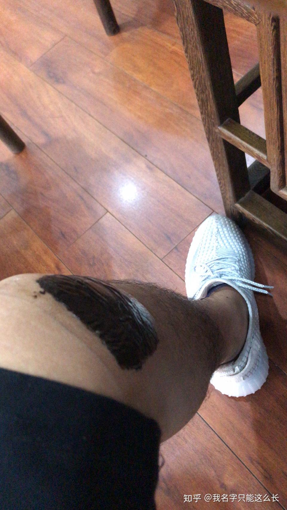 大腿右侧膝盖外侧的筋,扭到了好久,就是不好,平时走路也不影响,但是有