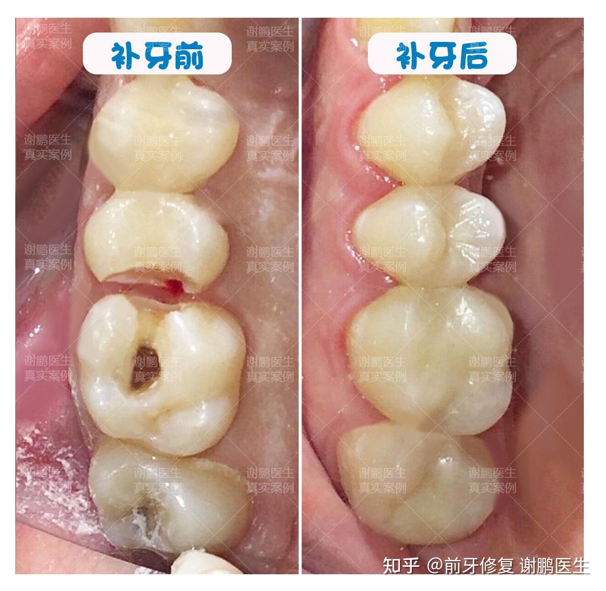 窝沟龋黑线面积不大伤害性极强