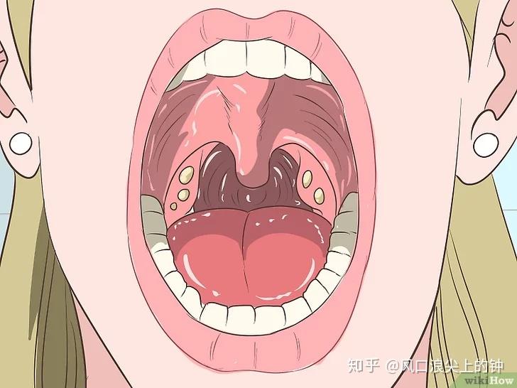 如何去除扁桃体结石转