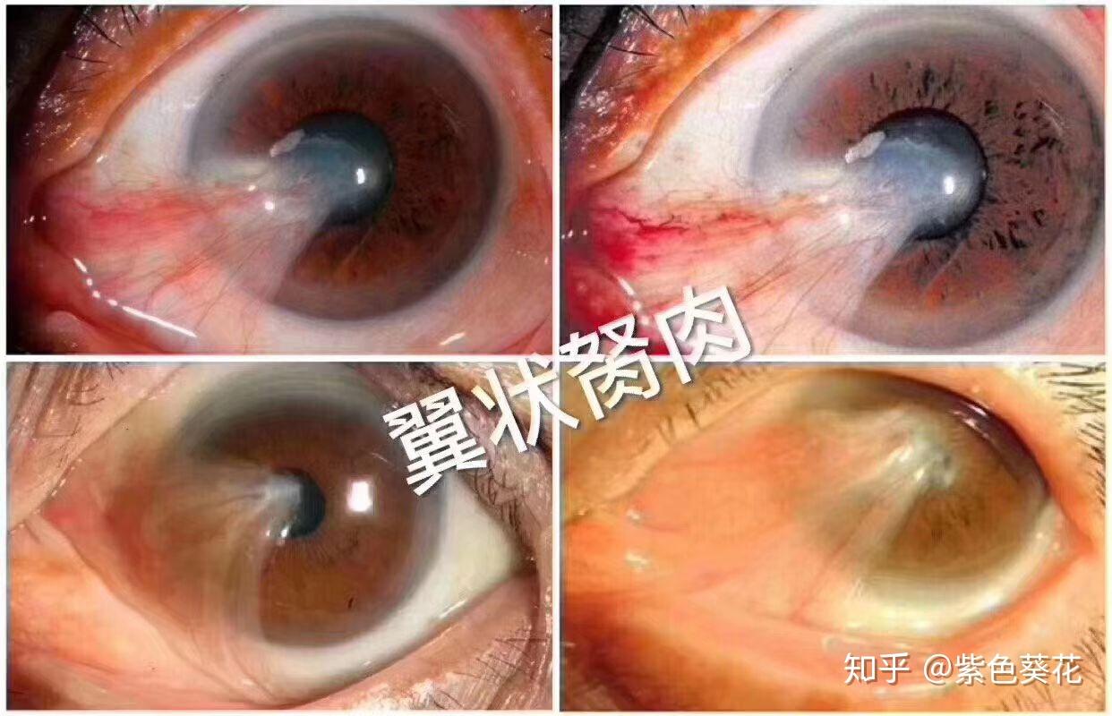 眼睛里面长息肉有什么危害? - 知乎