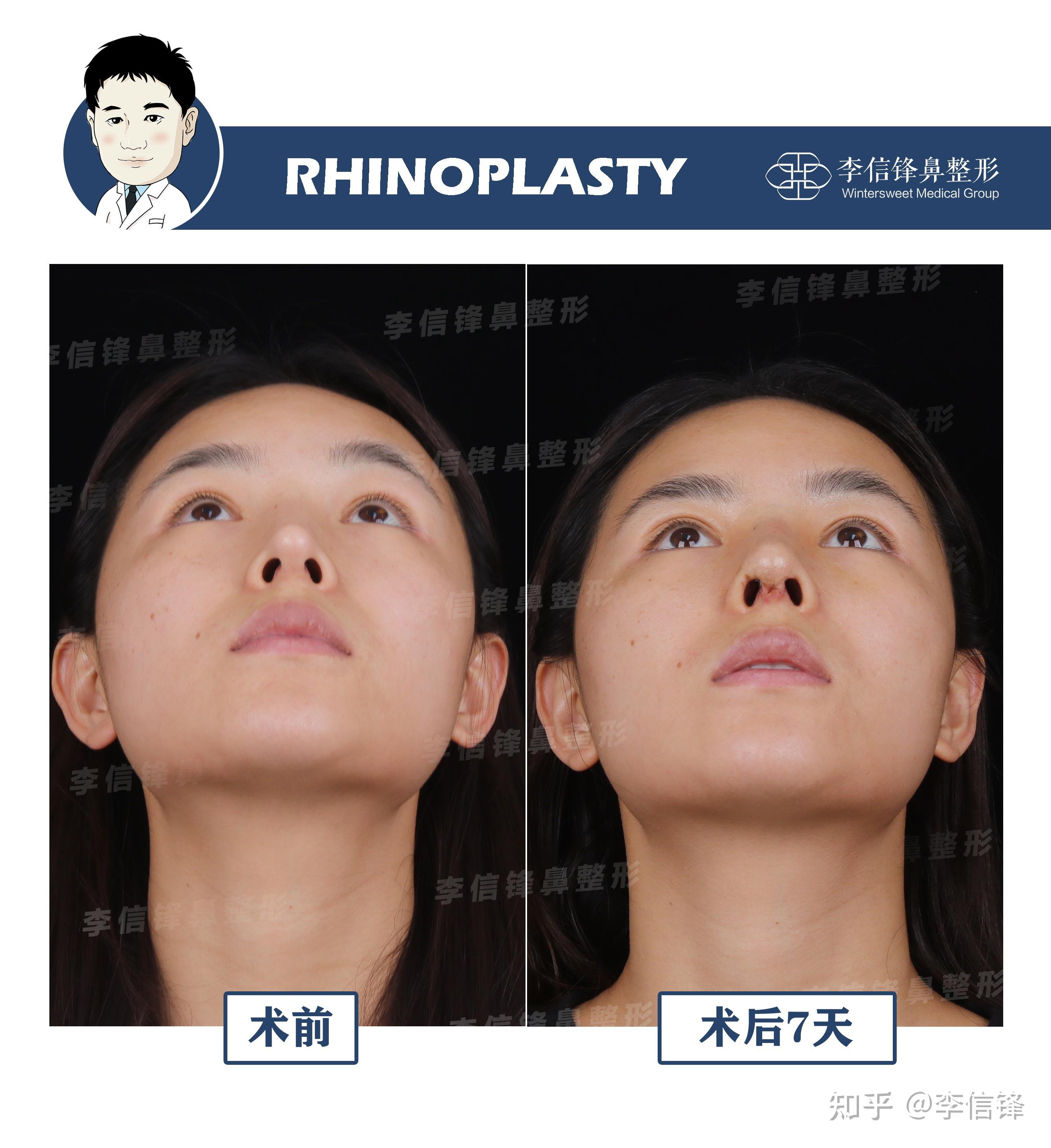 深圳李信锋鼻整形案例-长鼻缩短,精准调整比例,做完立马减龄显幼态~ - 知乎