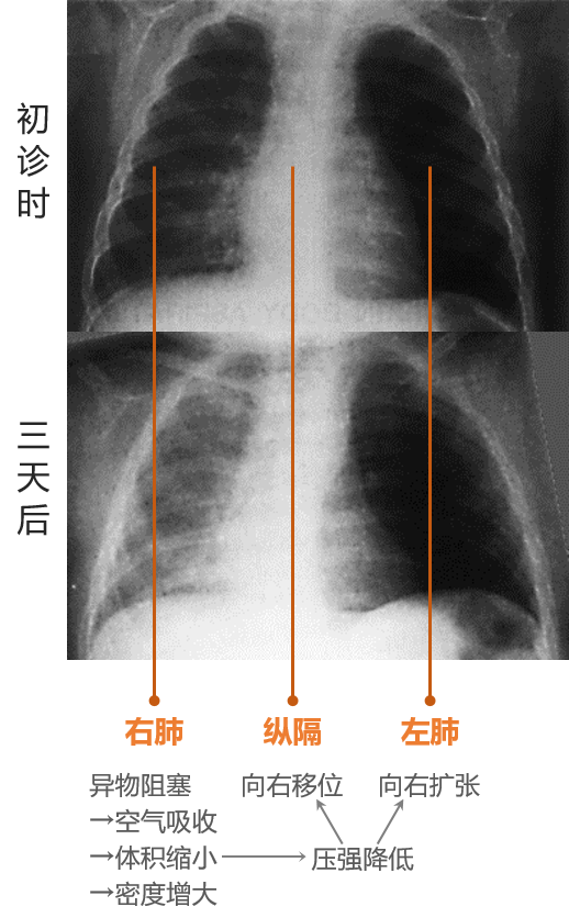 详解胸片变化,素材来源见正文杏林小草:怎么样萌萌,还觉得学习基础