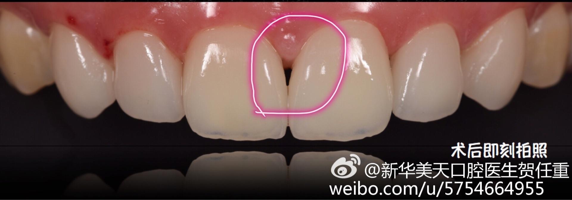 可以压入龈沟底清洁龈沟区,但不能压入沟底以下的组织,以防出现牙龈