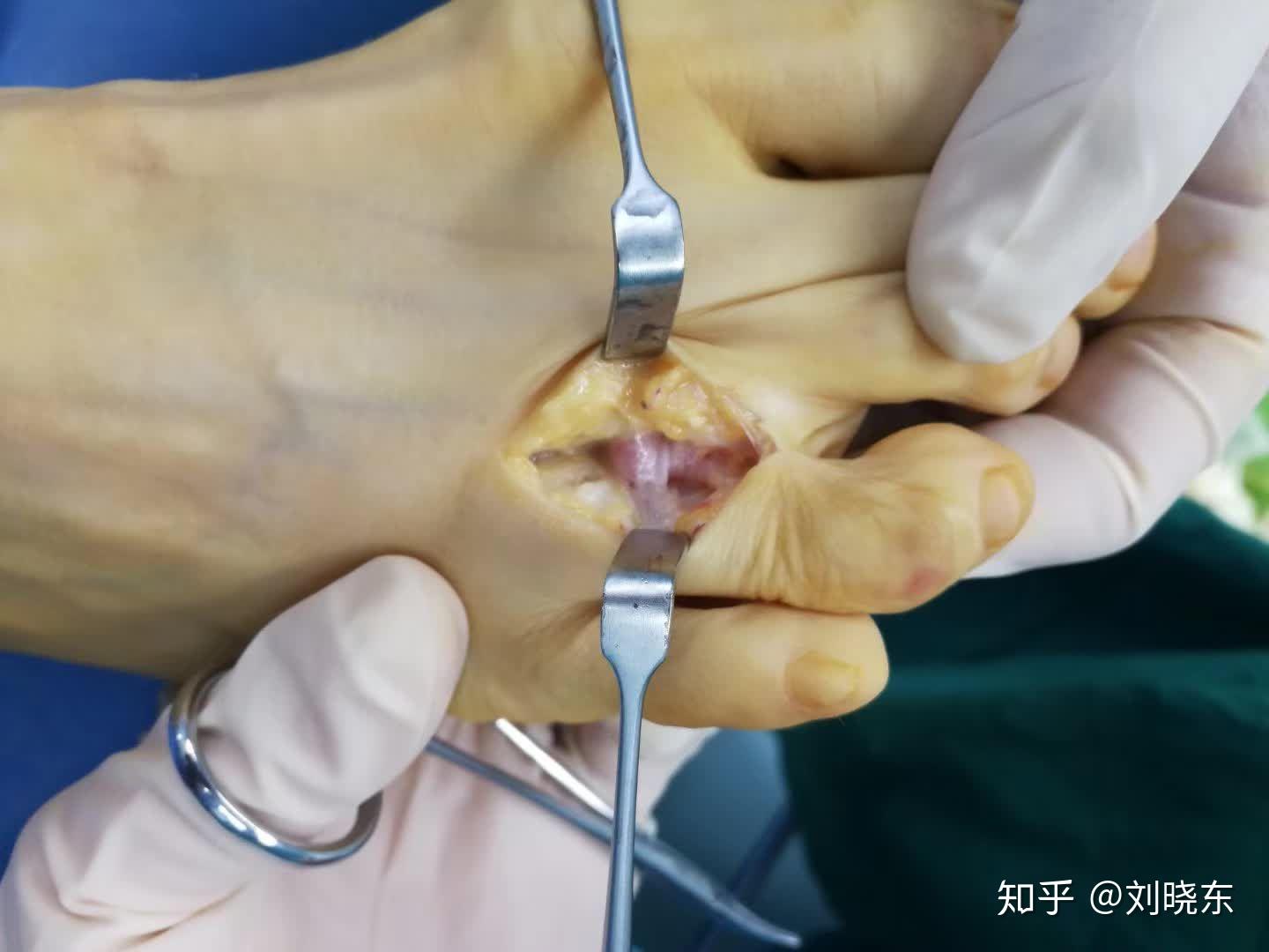 但前足痛的鉴别诊断十分广泛,而且医疗培训中提及的前足部问题通常