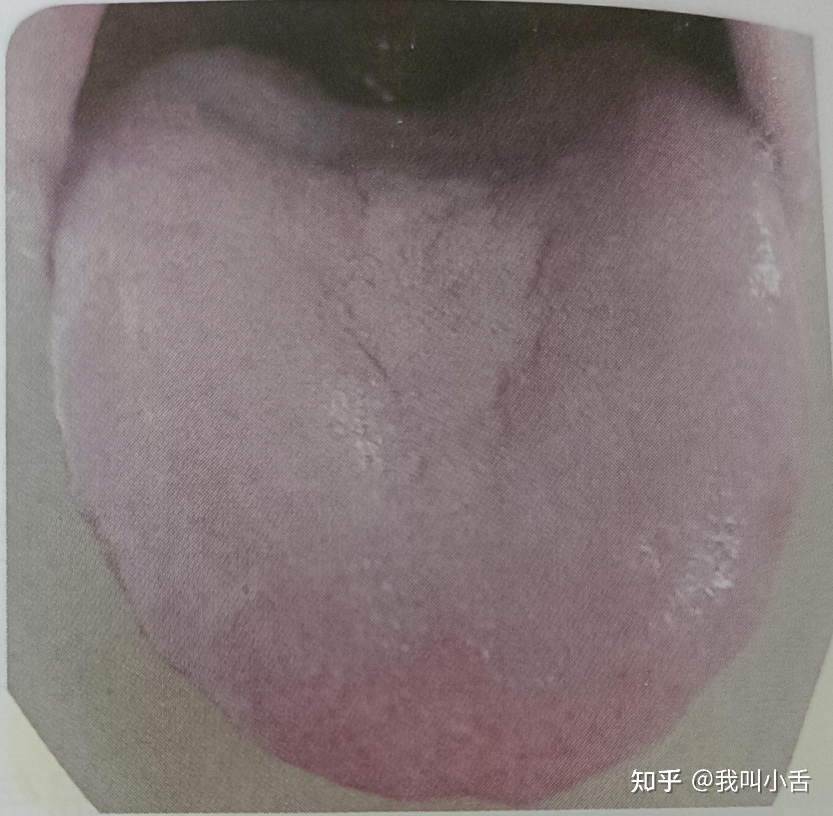 舌苔是如何形成的？白苔长什么样？如何判断自己的舌象呢？智能舌象助手来帮你！ - 知乎