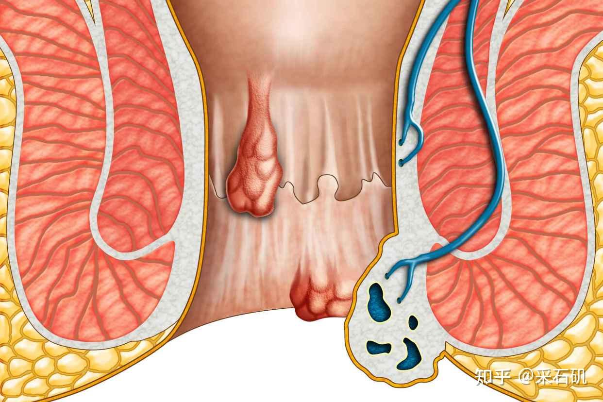 痔疮概念图图片