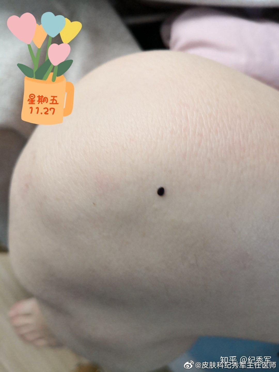 环钻治疗色素痣不缝线治疗前后对比图