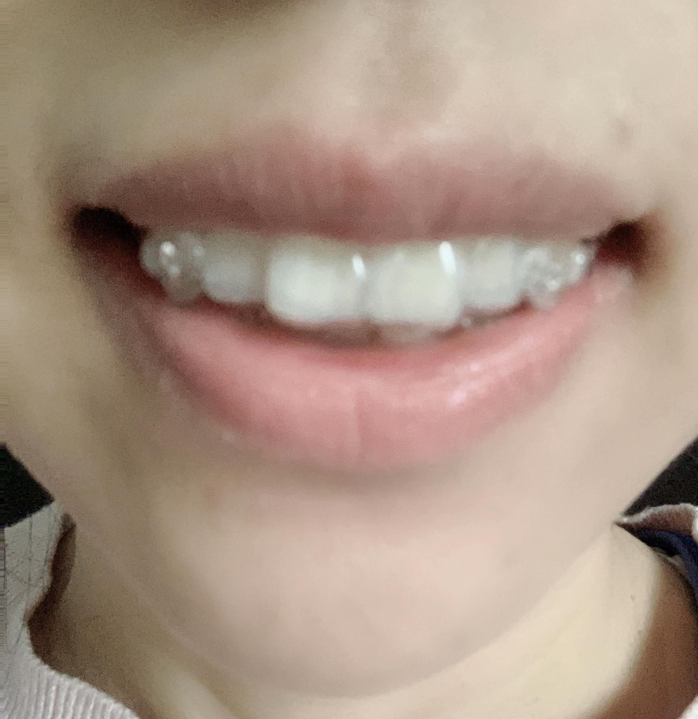 隐形牙套存在感强嘛