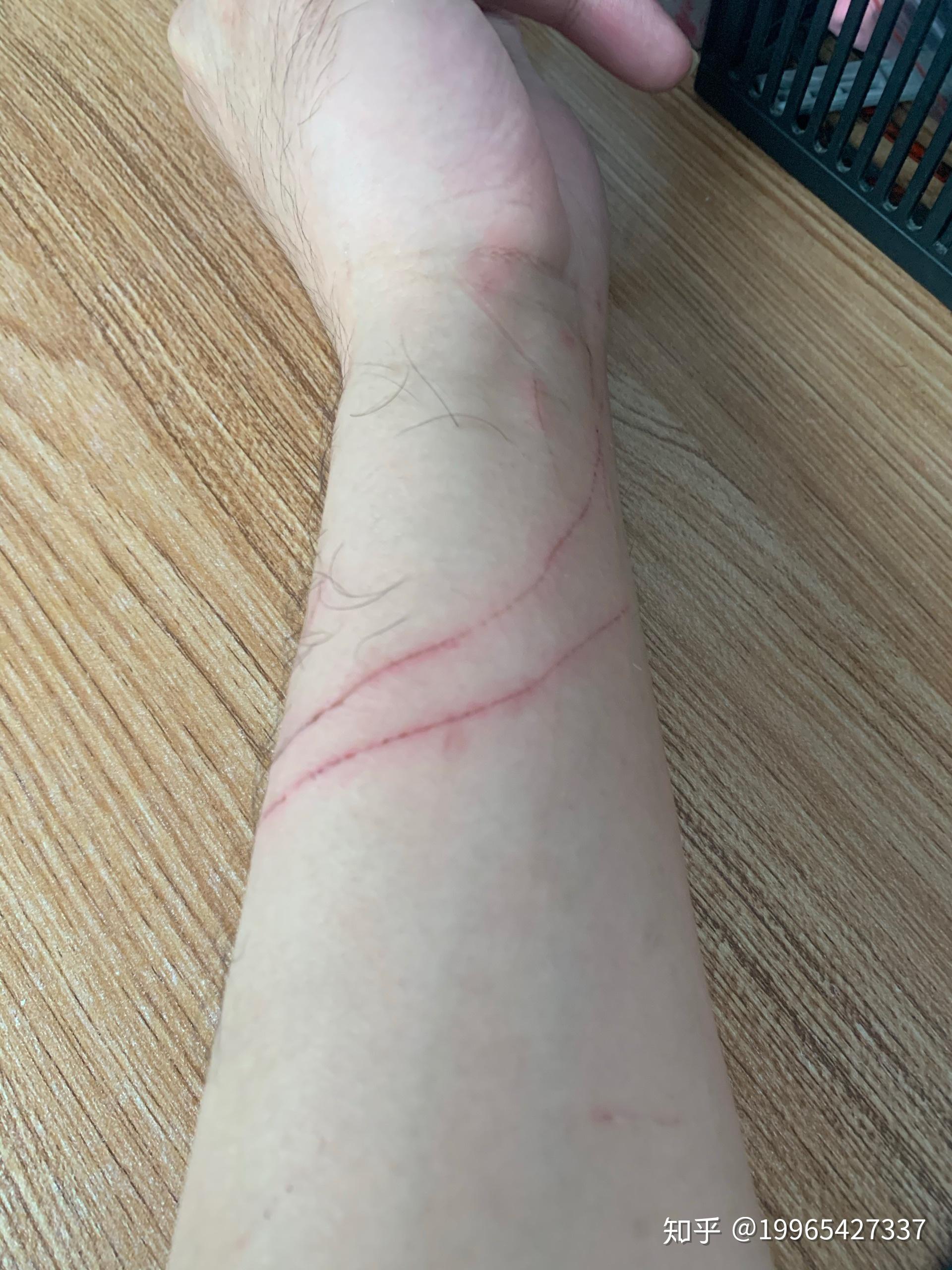 被猫轻微抓伤有关系吗