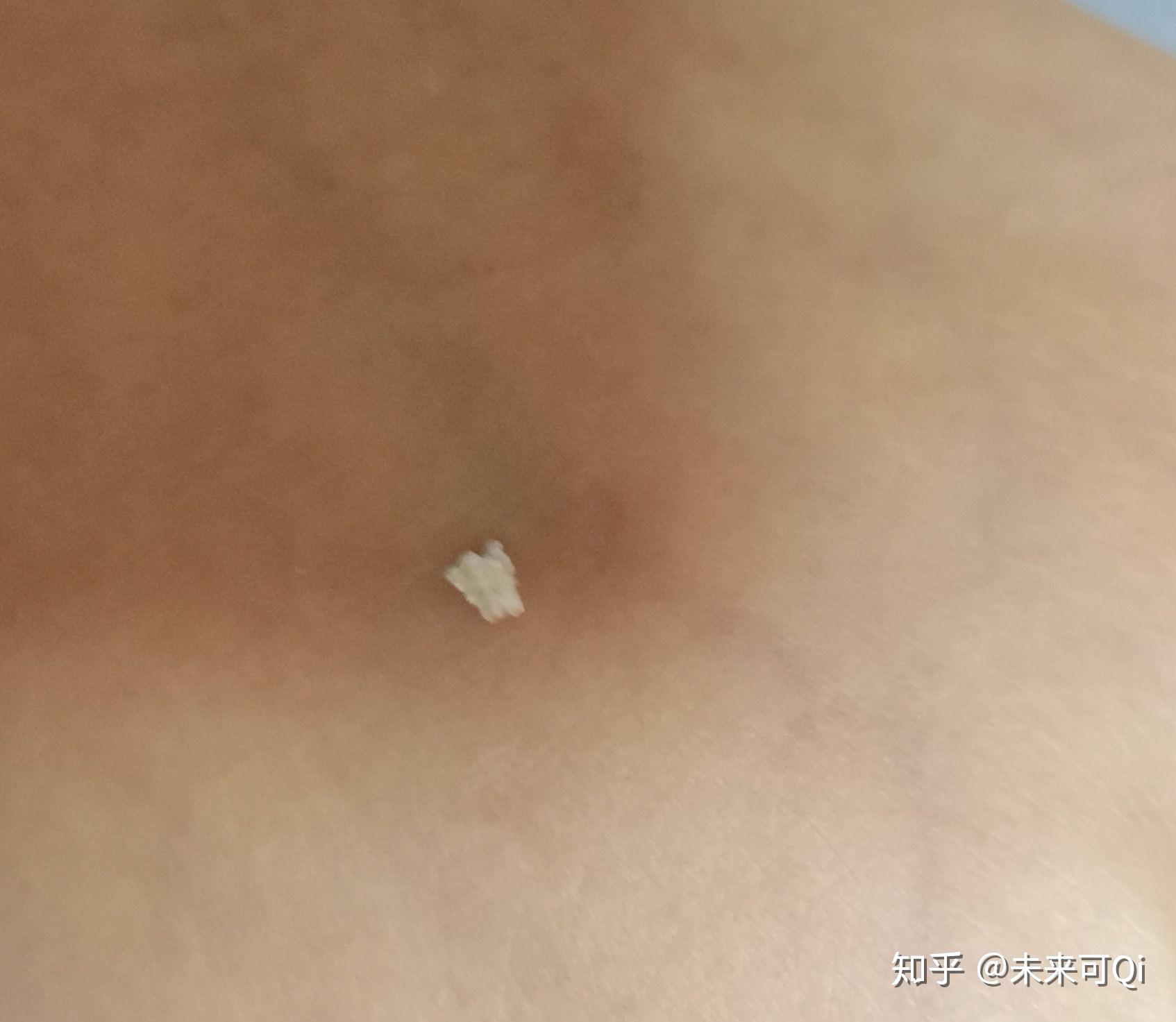 怎样快速止血大拇指 v2-ad4c51ec46370ad7ecd196675042b07f_r.jpg