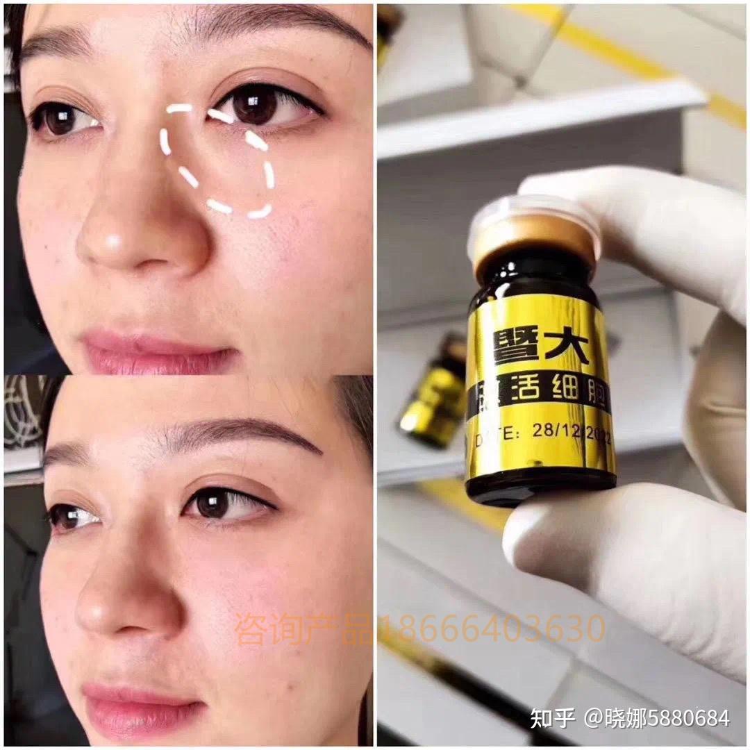 包含vsta暨大美容干细胞注射安全吗的词条