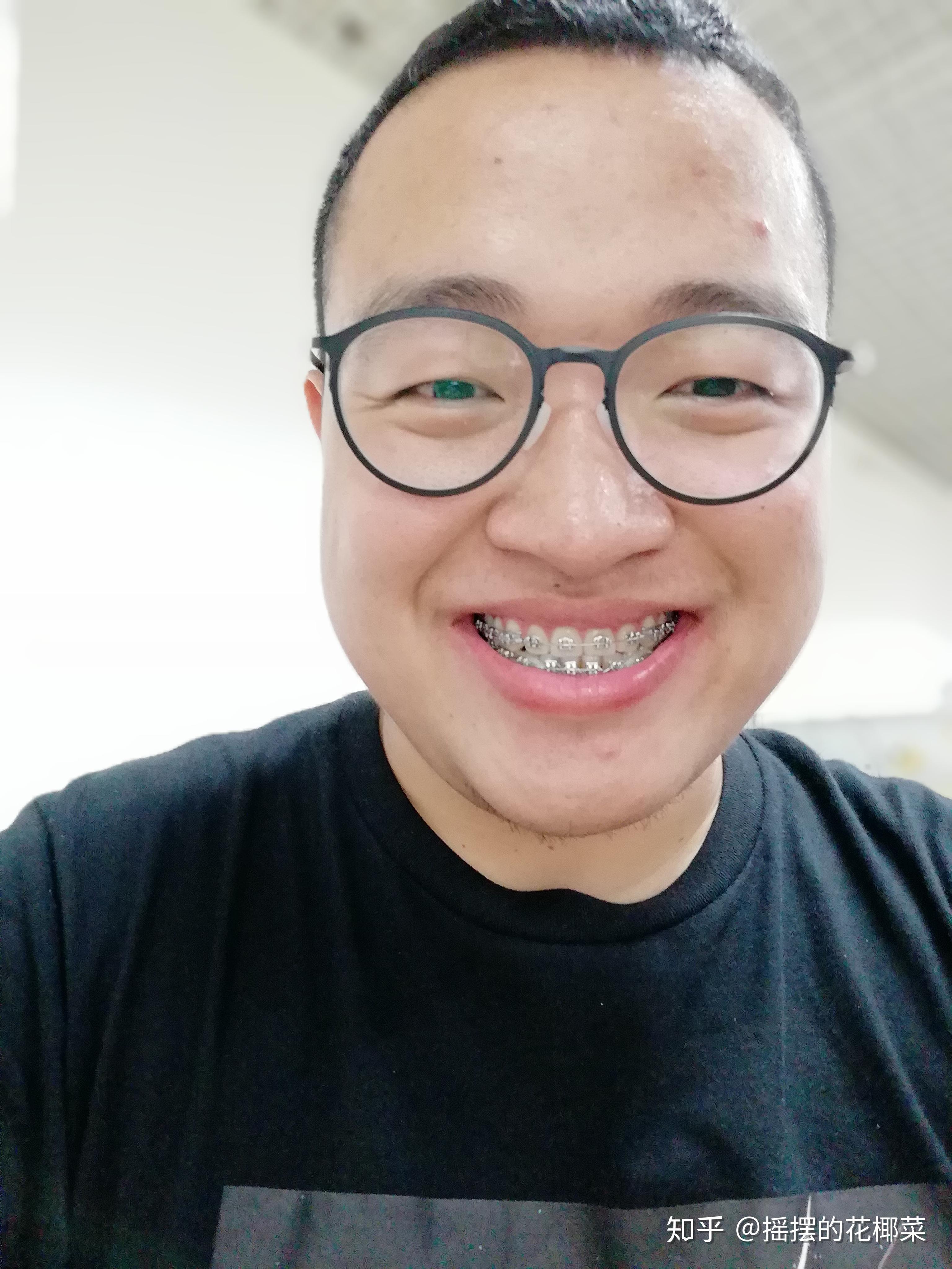 骨性反颌(轻微地包天)-对刃,中线不齐,牙齿缝隙大-26岁男-正畸记录