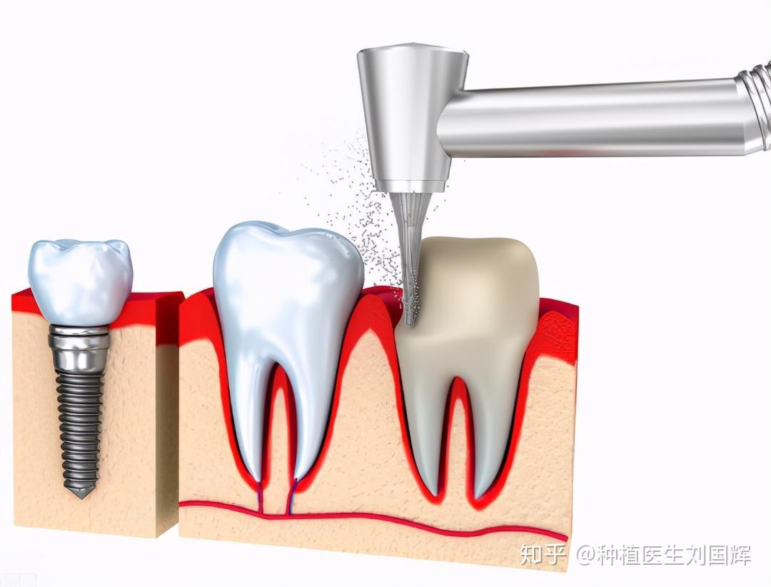 江苏省口腔医院—诊牙日记（根管治疗、补牙、拔牙、种牙 持续更新……） - 知乎