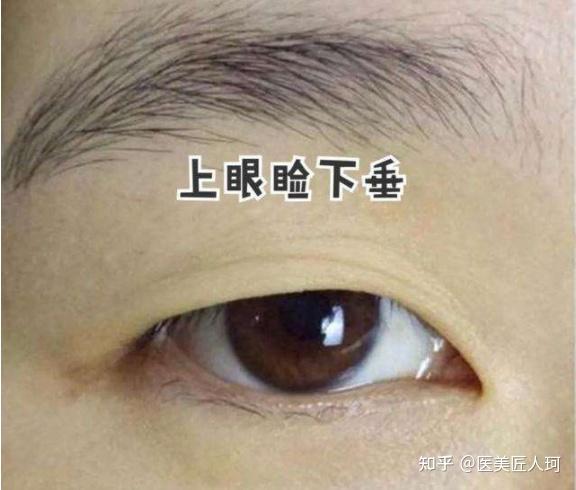 轻度上睑下垂需要做手术吗不做会严重吗