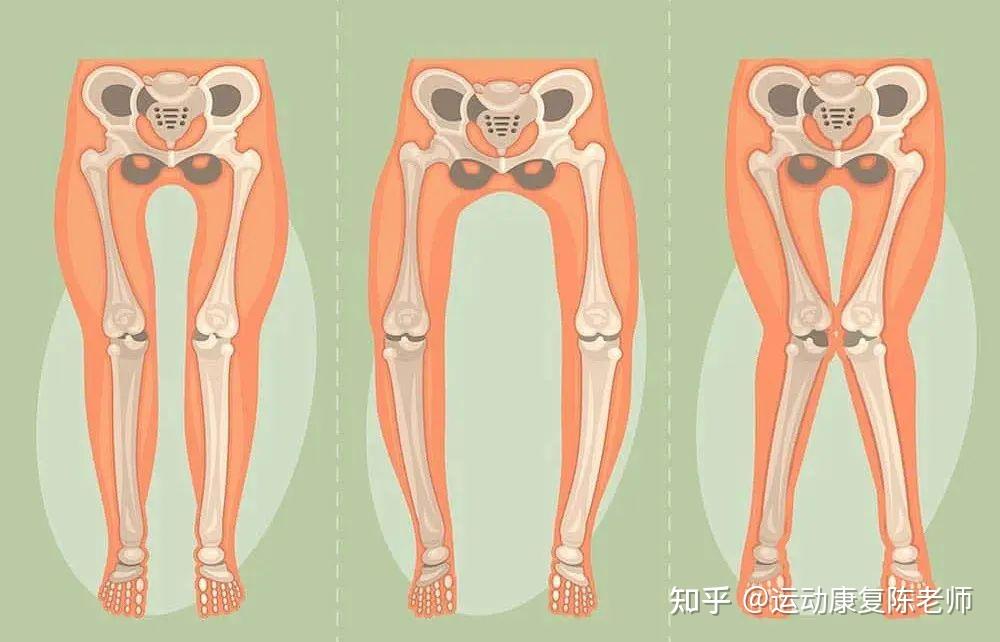 【锐博康复科普】科学解读下肢力线：如何改善X型腿和O型腿？ - 知乎