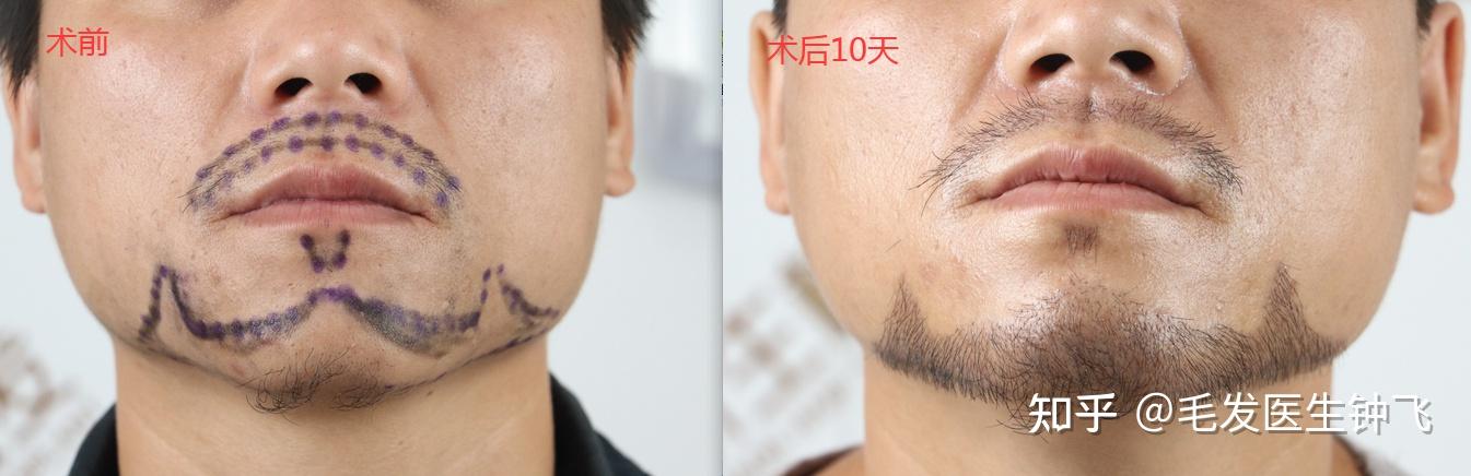 种植的胡须可以刮吗