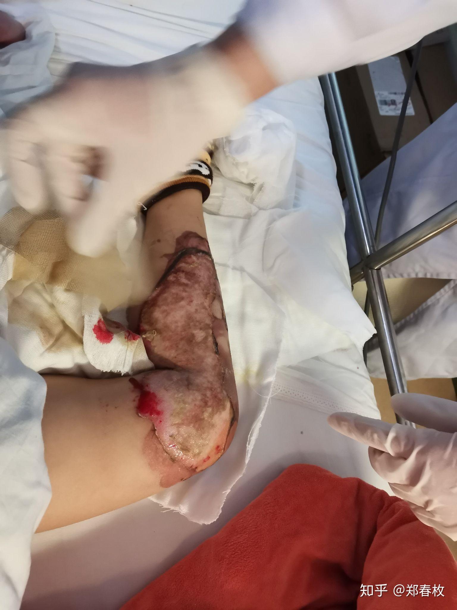 三岁小孩大面积烫伤