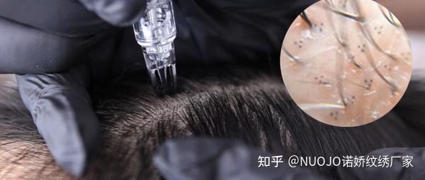 纹发大师人手必备：5D纹发脉冲仪做头皮点刺、发际线、发缝、鬓角等 - 知乎