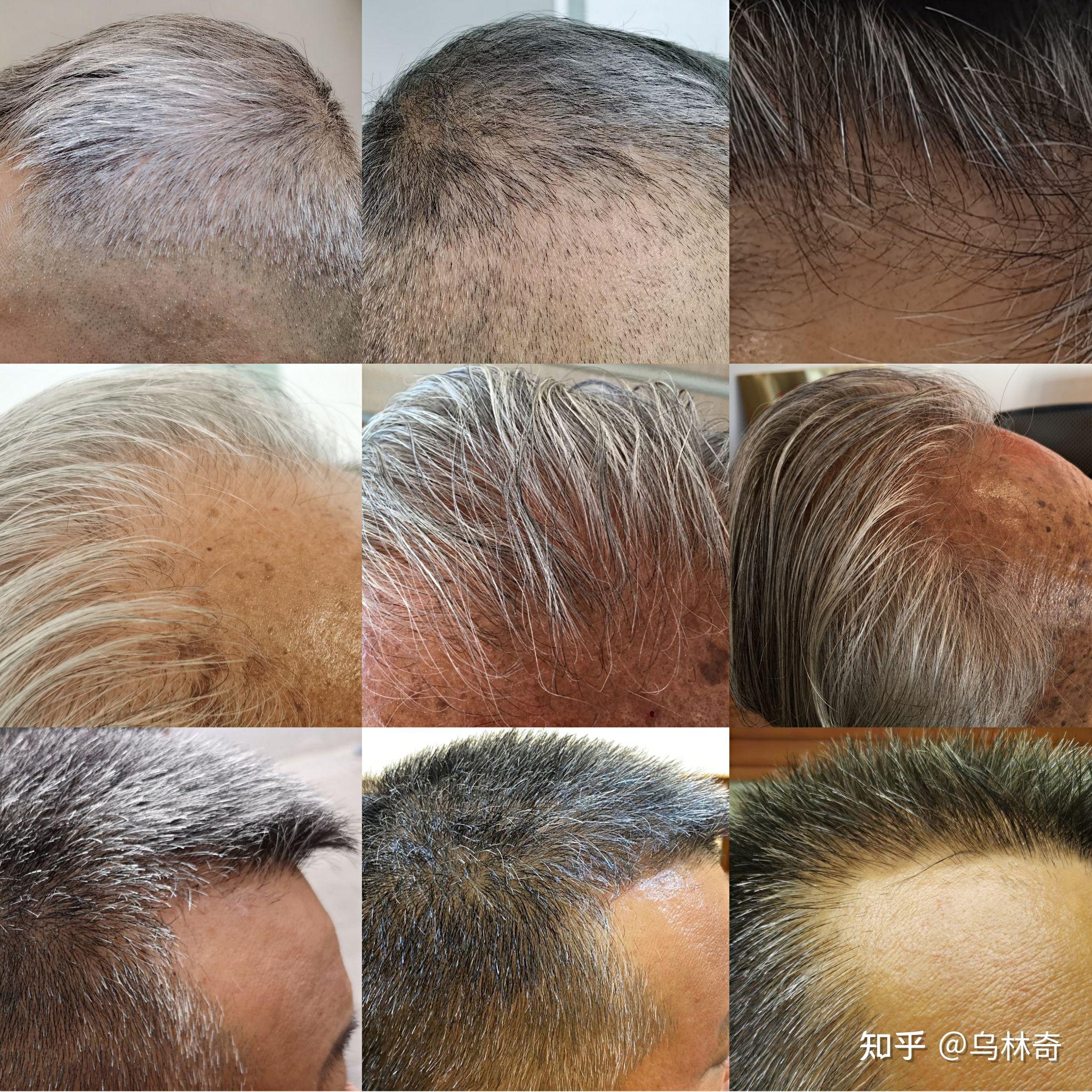 白发到底能不能转黑? - 知乎