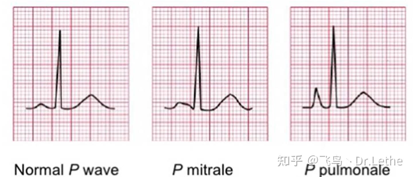 心电图基础知识概述 - 知乎