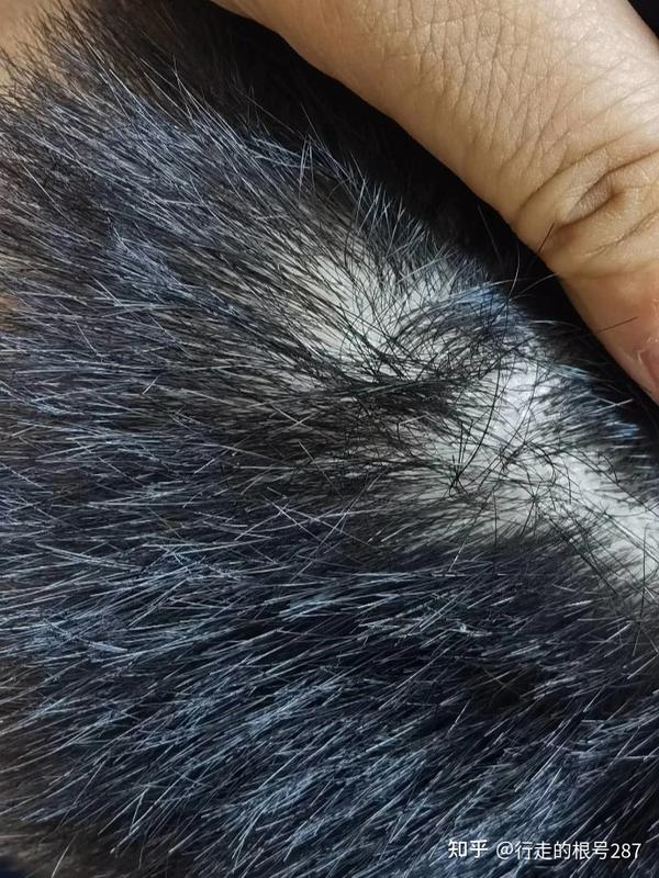 一,头皮发痒,头屑久治不愈