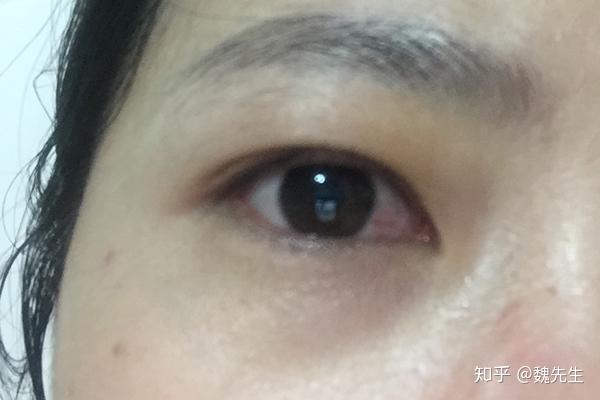 得了甲亢,身体6个症状较为突出,3类人应多留意,别疏忽 - 知乎