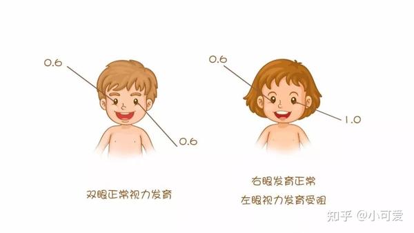 近视防控 关于弱视你了解多少 知乎
