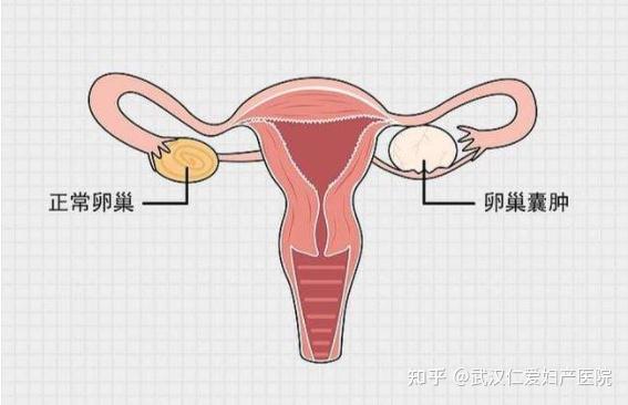 卵巢囊肿一般哪里会痛图片