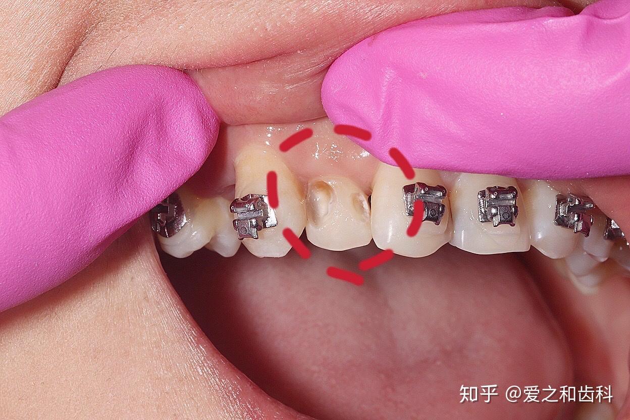 门牙缝隙出现黑点龋洞——邻面龋齿充填一例 - 知乎