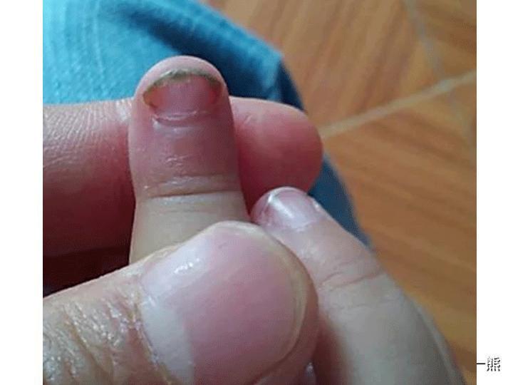 灰指甲7个月大孩童染上灰指甲