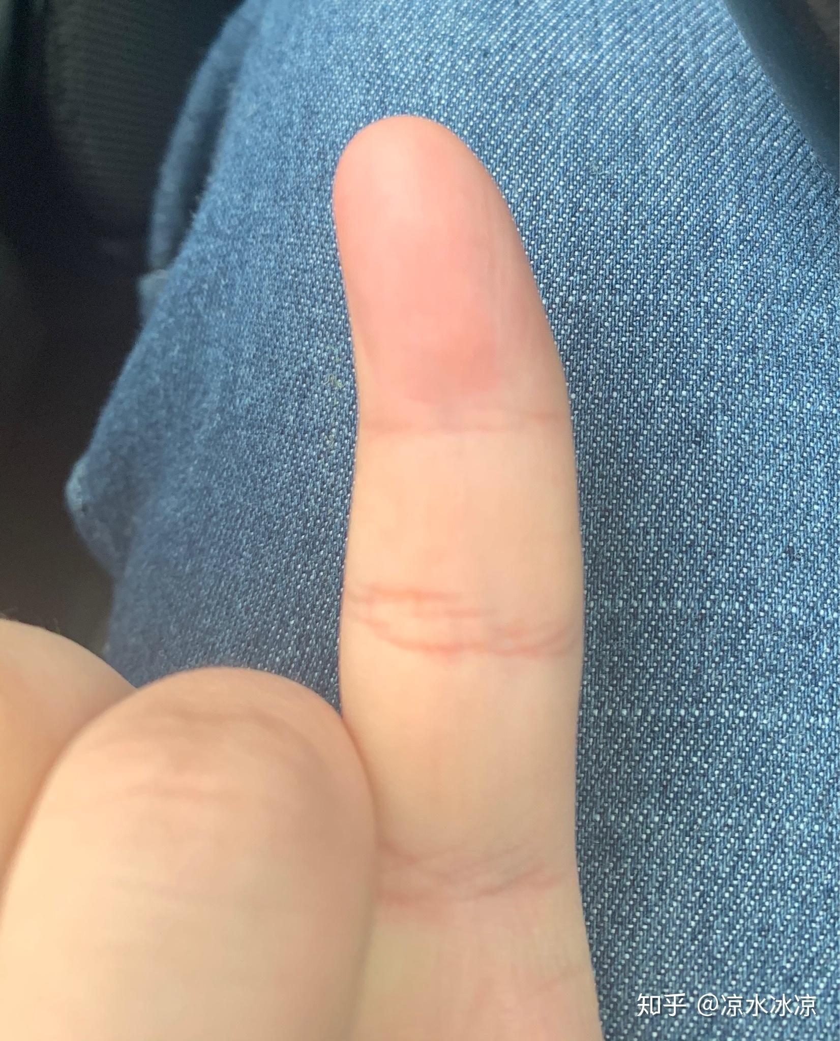 我的小拇指这样弯曲还有救吗