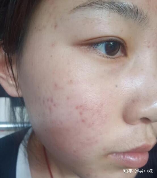 我脸上的红色痘印七八个月了,一直不下去,我该怎么办?