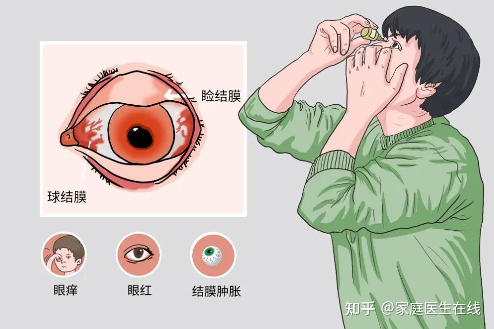 眼睛反复又红又痒,千万不要乱揉,小心结膜炎找上你 - 知乎