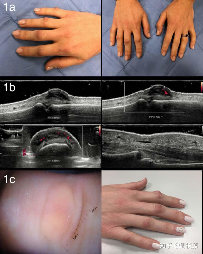 doi.org/10.4081/reumatismo.2021.1354 - 知乎
