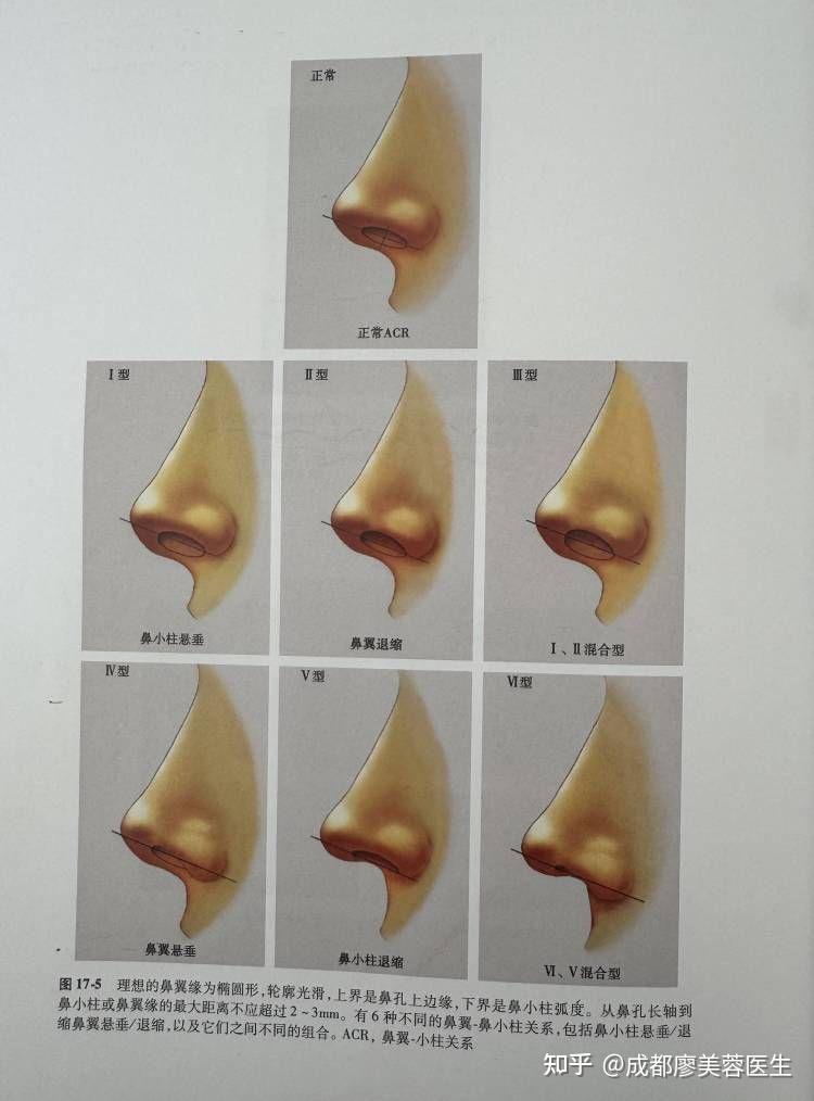 鼻翼缘退缩问题是如何出现的呢? - 知乎
