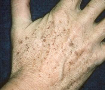 可怕困扰每个老人的老年斑怎样才能有效祛除老年斑呢