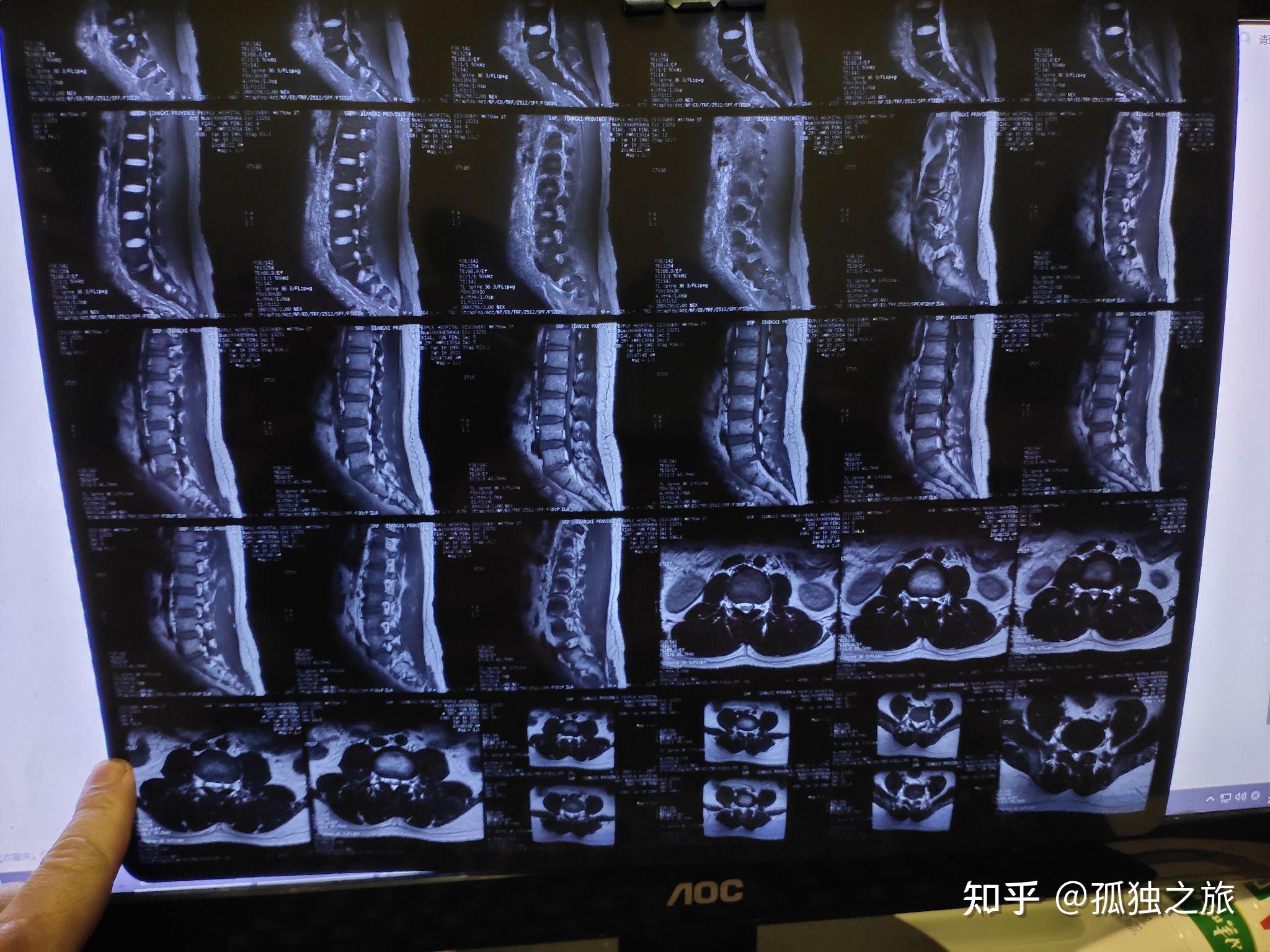 又開始上班了(又作死),於三個月的的時候複查了核磁共振,顯示還有突出