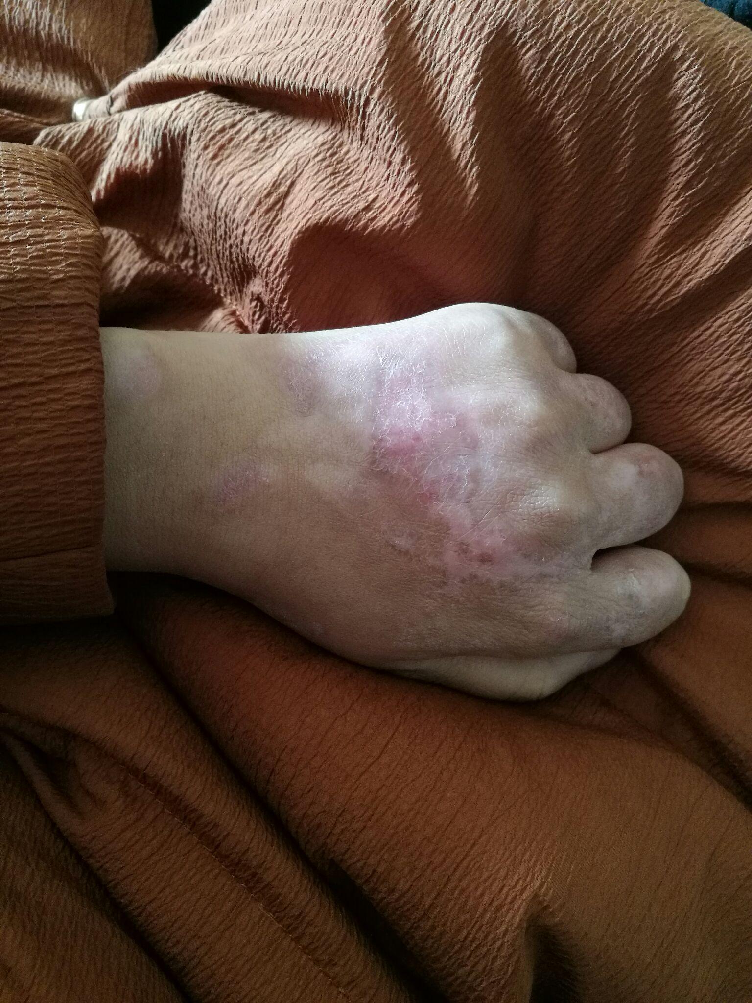 右手手背有很大疤痕,很自卑,找工作特别难,怎么办? - 知乎