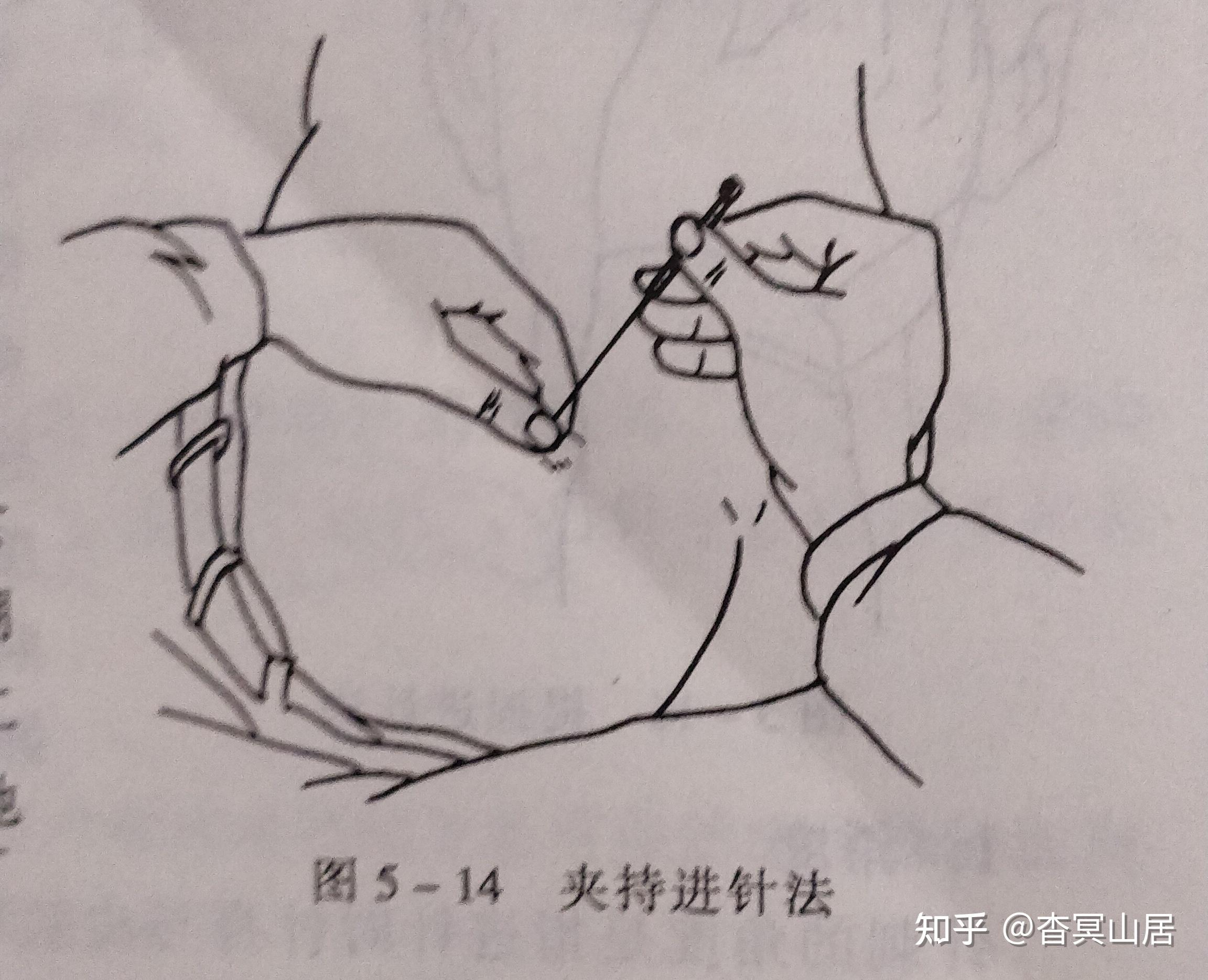 笔记摘要——针灸技术:毫针刺法、补泻原则与灸法概要 - 知乎