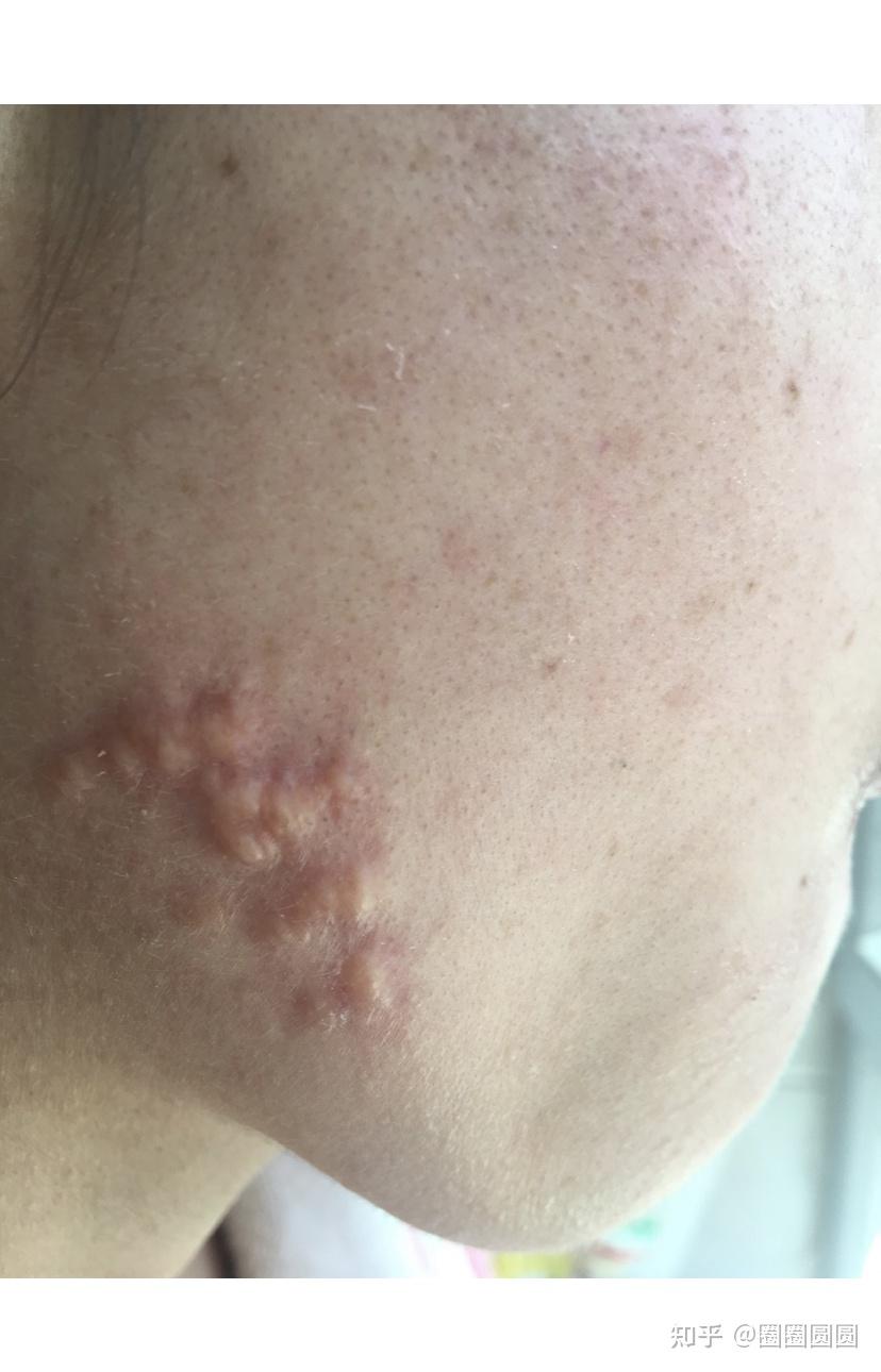 记录我跟疤痕增生一起战斗的日子 - 知乎