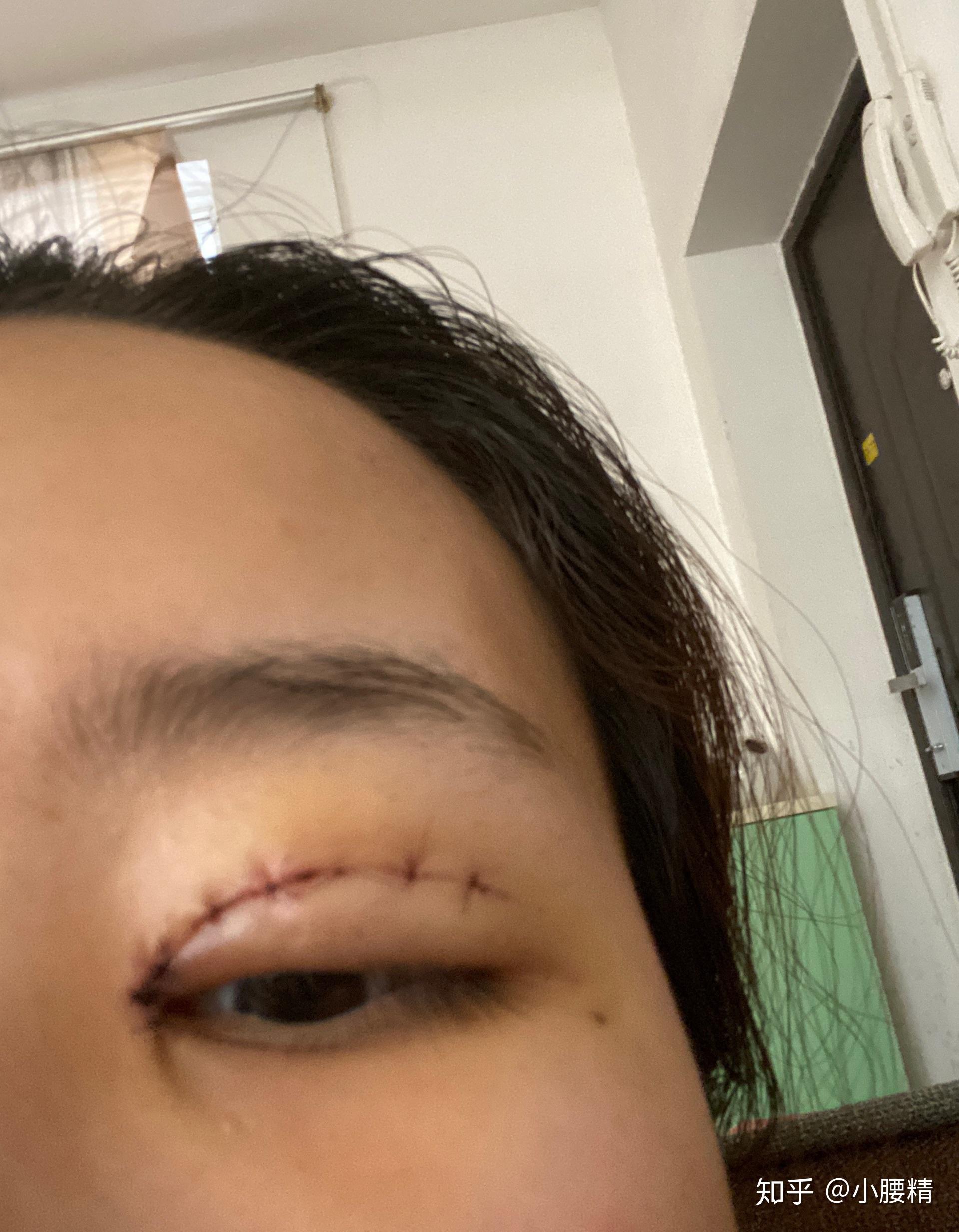 割完双眼皮第4天